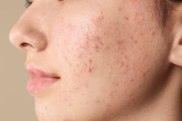 wat te doen tegen acne